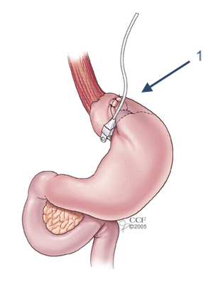 Adjustable Gastric Band 