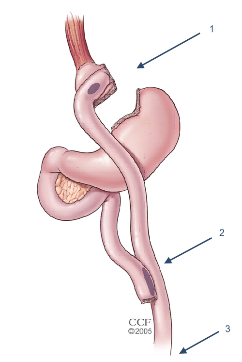 Gastric Bypass illustration