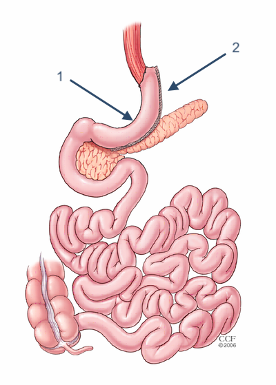 Sleeve Gastrectomy illustration