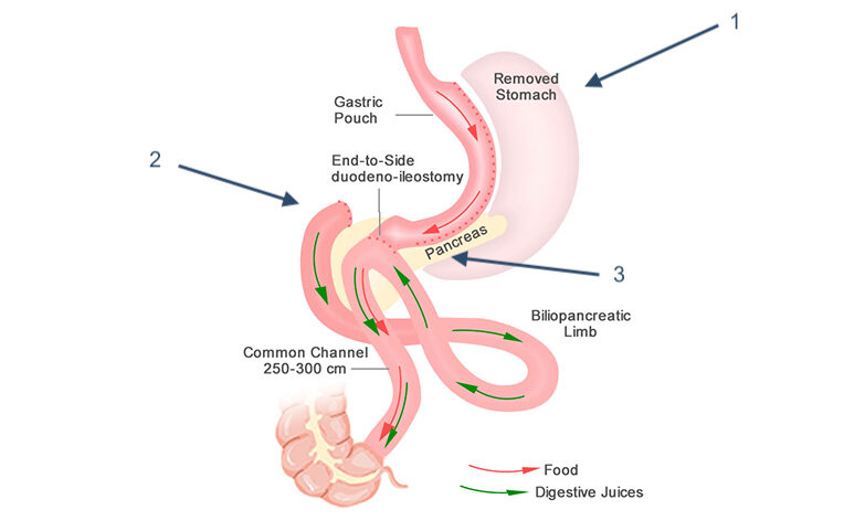 Biliopancreatic Diversion with Duodenal Switch illustration