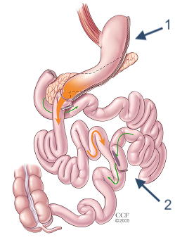 Biliopancreatic Diversion with Duodenal Switch illustration